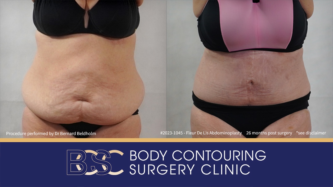 Fleur-de-Lis Abdominoplasty and Upper Abdominal Lipectomy Post Weight Loss (Patient 2023-1045)