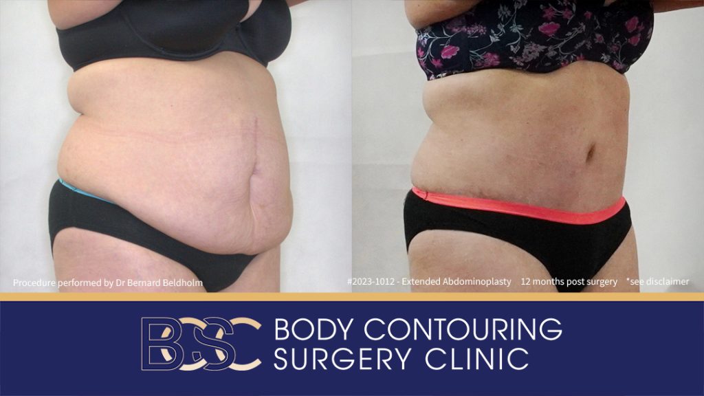 Abdominoplasty Post Weight Loss and Post Pregnancy, Including Repair of Diastasis Recti and VASER liposuction (Patient 2023-1012) - Left