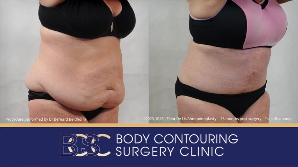 Fleur-de-Lis Abdominoplasty and Upper Abdominal Lipectomy Post Weight Loss (Patient 2023-1045) - Left