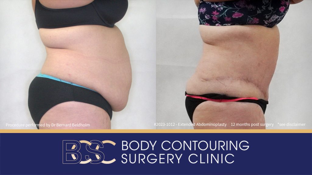 Abdominoplasty Post Weight Loss and Post Pregnancy, Including Repair of Diastasis Recti and VASER liposuction (Patient 2023-1012) - Left Side