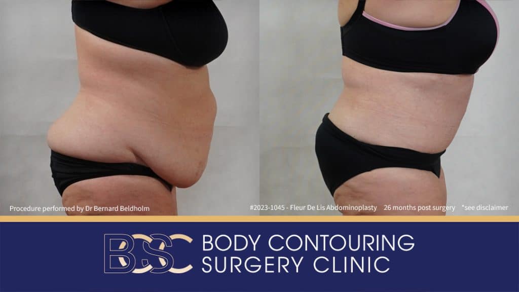 Fleur-de-Lis Abdominoplasty and Upper Abdominal Lipectomy Post Weight Loss (Patient 2023-1045) - Left Side