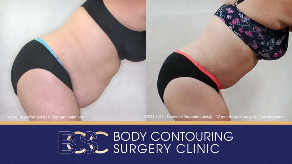 Abdominoplasty Post Weight Loss and Post Pregnancy, Including Repair of Diastasis Recti and VASER liposuction (Patient 2023-1012) - Left Side Bend