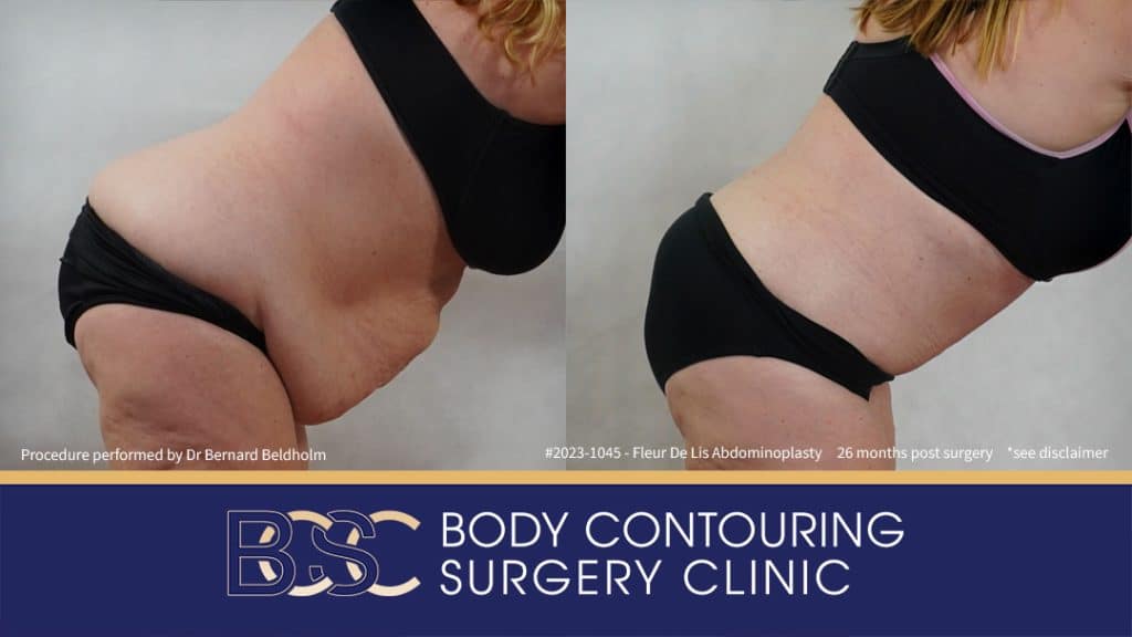 Fleur-de-Lis Abdominoplasty and Upper Abdominal Lipectomy Post Weight Loss (Patient 2023-1045) - Left Side Bend