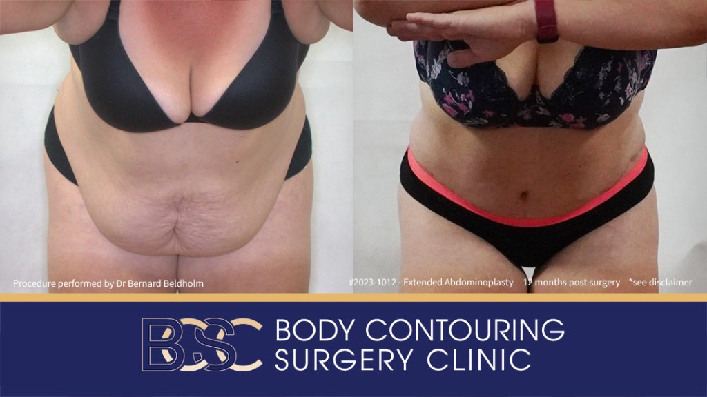 Abdominoplasty Post Weight Loss and Post Pregnancy, Including Repair of Diastasis Recti and VASER liposuction (Patient 2023-1012) - Front Bend