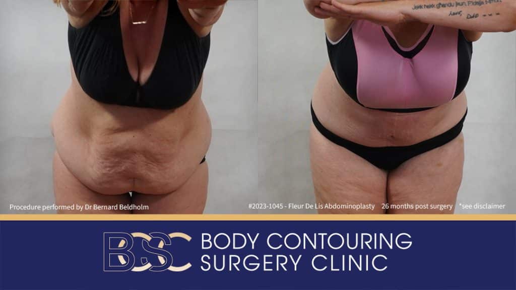 Fleur-de-Lis Abdominoplasty and Upper Abdominal Lipectomy Post Weight Loss (Patient 2023-1045) - Front Bend