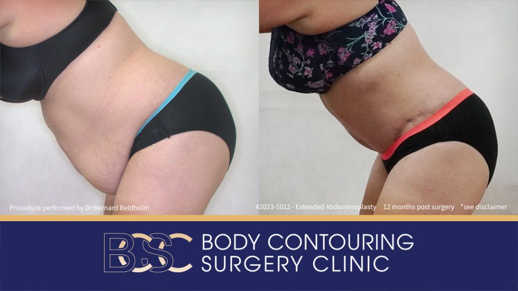 Abdominoplasty Post Weight Loss and Post Pregnancy, Including Repair of Diastasis Recti and VASER liposuction (Patient 2023-1012) - Right Side Bend