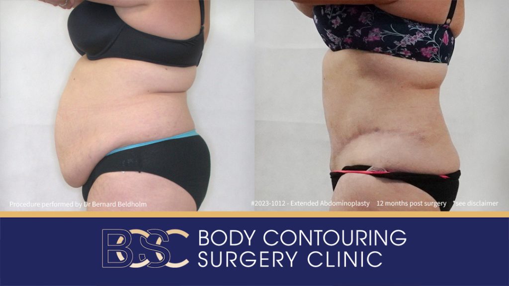 Abdominoplasty Post Weight Loss and Post Pregnancy, Including Repair of Diastasis Recti and VASER liposuction (Patient 2023-1012) - Right Side