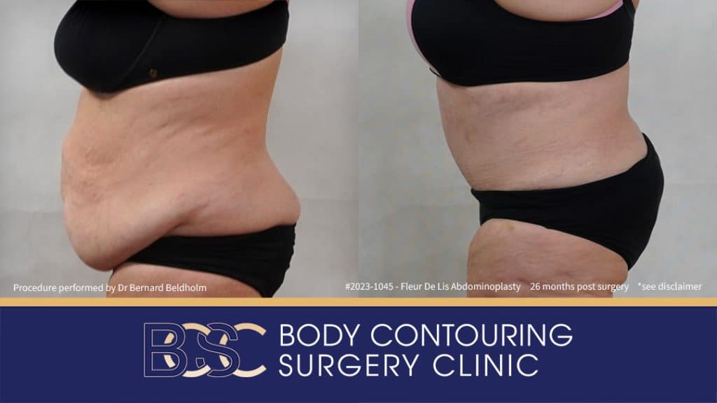 Fleur-de-Lis Abdominoplasty and Upper Abdominal Lipectomy Post Weight Loss (Patient 2023-1045) - Right Side