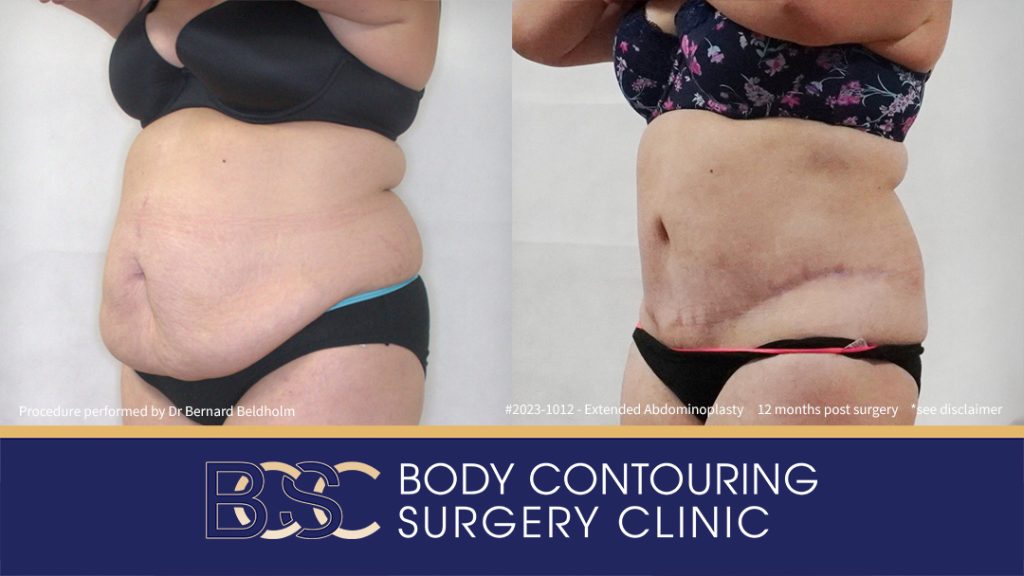 Abdominoplasty Post Weight Loss and Post Pregnancy, Including Repair of Diastasis Recti and VASER liposuction (Patient 2023-1012) - Right