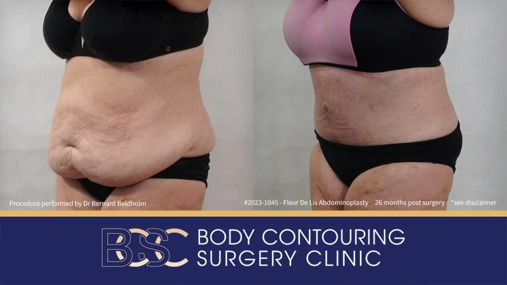 Fleur-de-Lis Abdominoplasty and Upper Abdominal Lipectomy Post Weight Loss (Patient 2023-1045) - Right