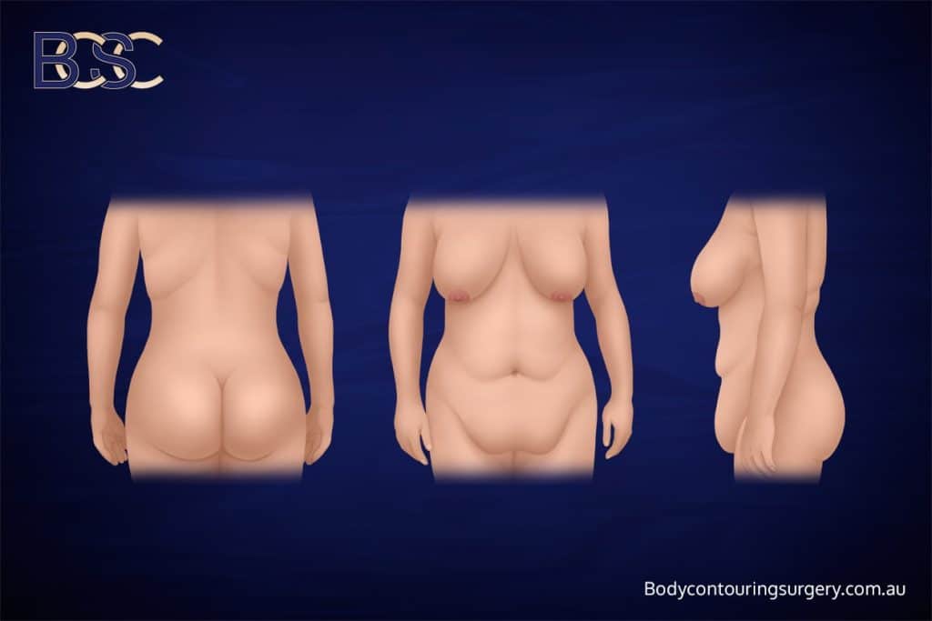 The Effect of Weight Changes After Surgery