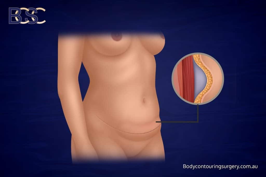 Abdominal seroma