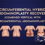Recovery After a Circumferential Hybrid Abdominoplasty