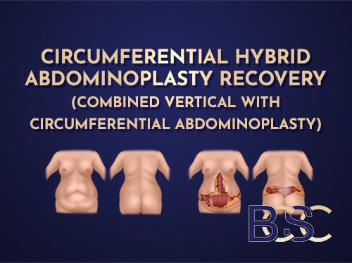 Recovery After a Circumferential Hybrid Abdominoplasty