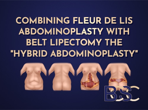Circumferential Hybrid Abdominoplasty Combining a Vertical Lipectomy with Belt Lipectomy