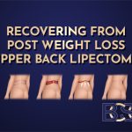 Bra Lipectomy (upper back lipectomy) Recovery: Recovering From a Bra Line Back Lift