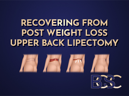 Bra Lipectomy (upper back lipectomy) Recovery: Recovering From a Bra Line Back Lift