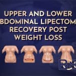 Upper and Lower Abdominal Lipectomy Recovery Post Weight Loss