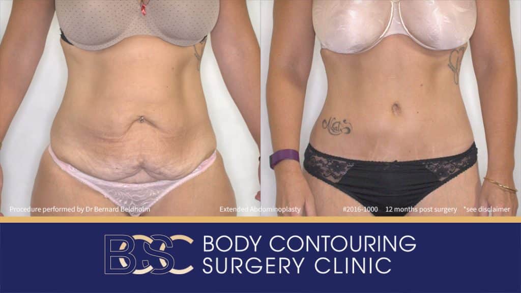 Extended Abdominoplasty (Tummy Tuck) After 50kg of Weight Loss (Patient 2016-1000) - Front