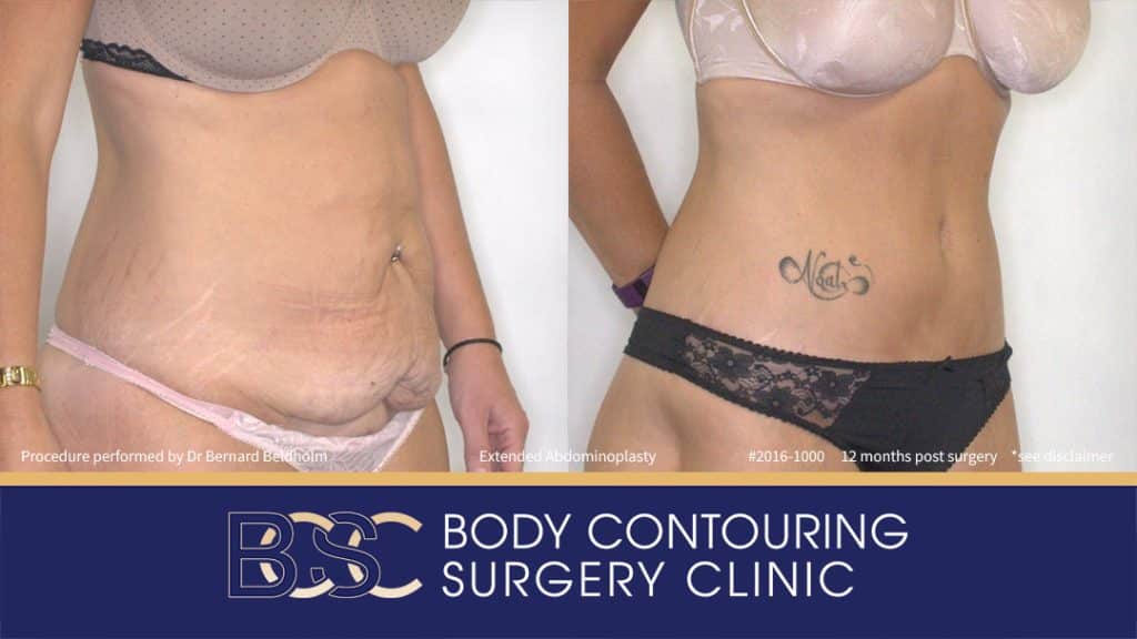 Extended Abdominoplasty (Tummy Tuck) After 50kg of Weight Loss (Patient 2016-1000) - Left