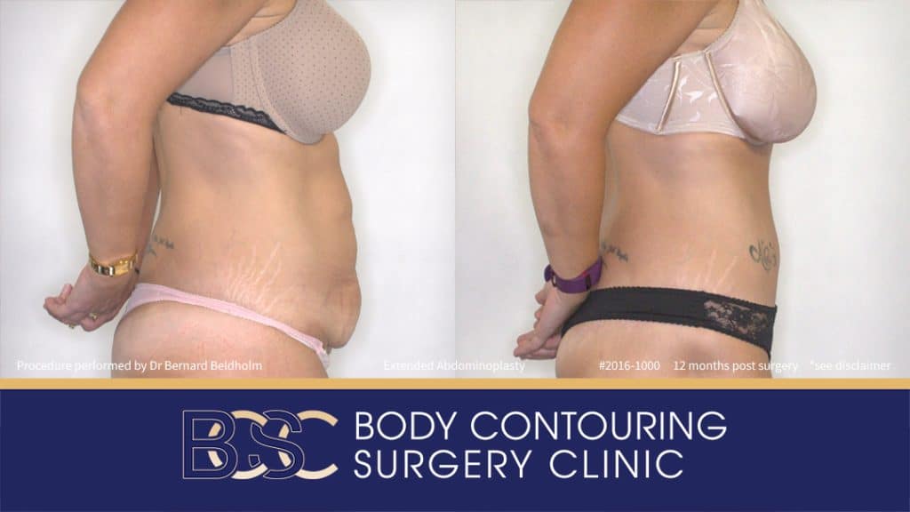 Extended Abdominoplasty (Tummy Tuck) After 50kg of Weight Loss (Patient 2016-1000) - Left Side