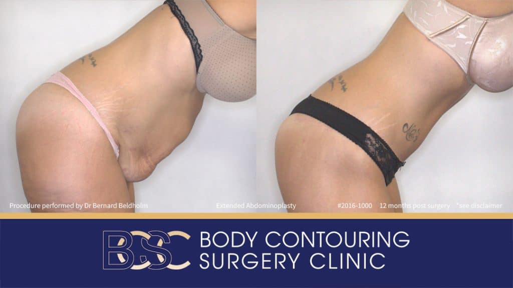 Extended Abdominoplasty (Tummy Tuck) After 50kg of Weight Loss (Patient 2016-1000) - Left Side Bend