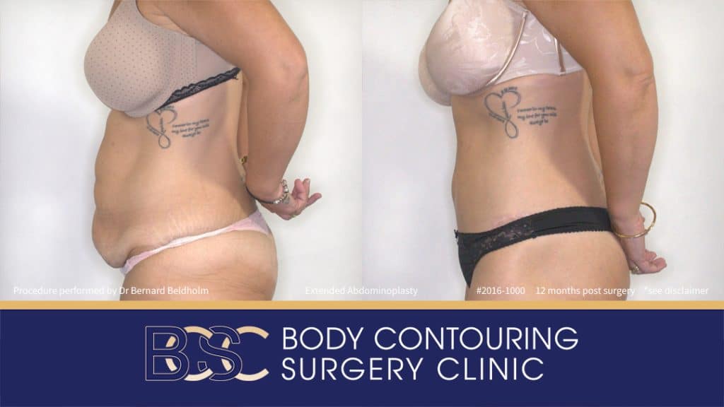 Extended Abdominoplasty (Tummy Tuck) After 50kg of Weight Loss (Patient 2016-1000) - Right Side