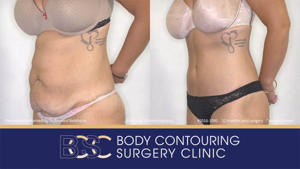 Extended Abdominoplasty (Tummy Tuck) After 50kg of Weight Loss (Patient 2016-1000) - Right
