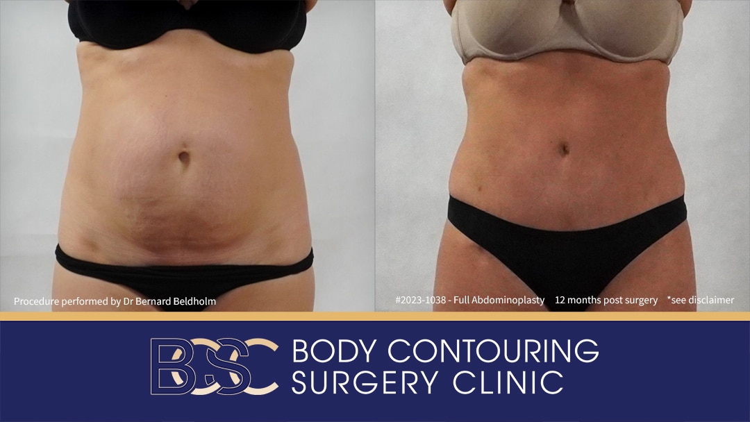 Abdominoplasty with VASER Liposuction (Suction-assisted Lipectomy) and Diastasis Recti Repair | 12 Months Post Surgery | Patient 2023-1038 - Front