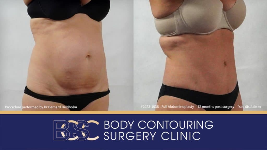 Abdominoplasty with VASER Liposuction (Suction-assisted Lipectomy) and Diastasis Recti Repair | 12 Months Post Surgery | Patient 2023-1038 - Left