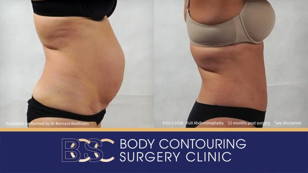 Abdominoplasty with VASER Liposuction (Suction-assisted Lipectomy) and Diastasis Recti Repair | 12 Months Post Surgery | Patient 2023-1038 - Left Side