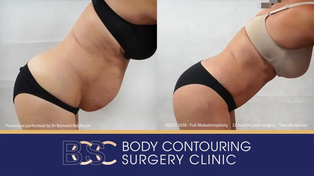 Abdominoplasty with VASER Liposuction (Suction-assisted Lipectomy) and Diastasis Recti Repair | 12 Months Post Surgery | Patient 2023-1038 - Left Side Bend