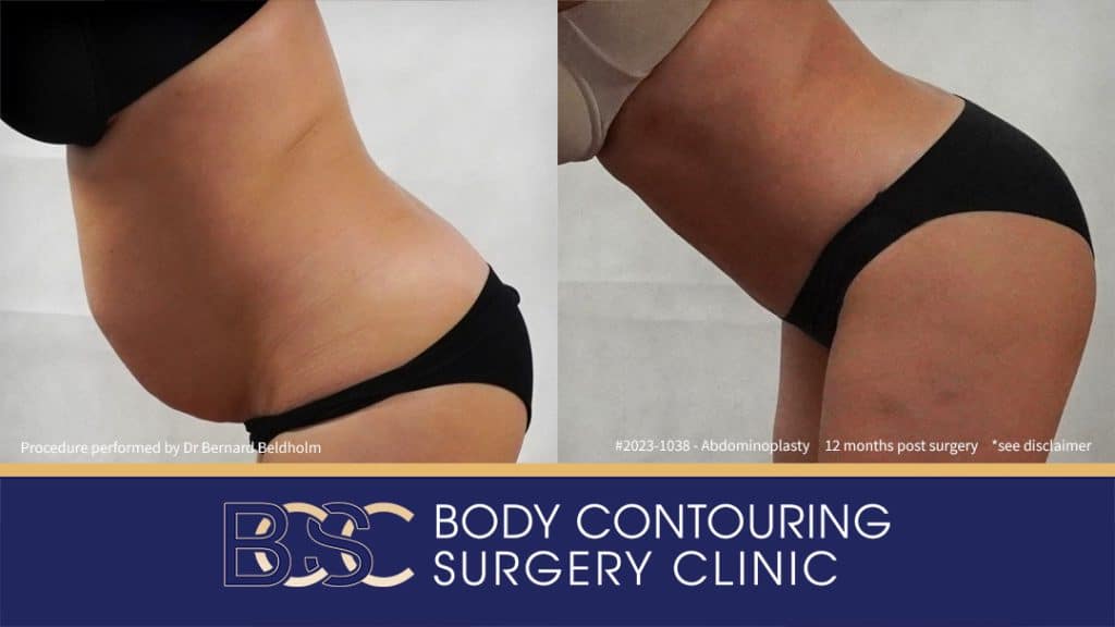 Abdominoplasty with VASER Liposuction (Suction-assisted Lipectomy) and Diastasis Recti Repair | 12 Months Post Surgery | Patient 2023-1038 - Right Side Bend