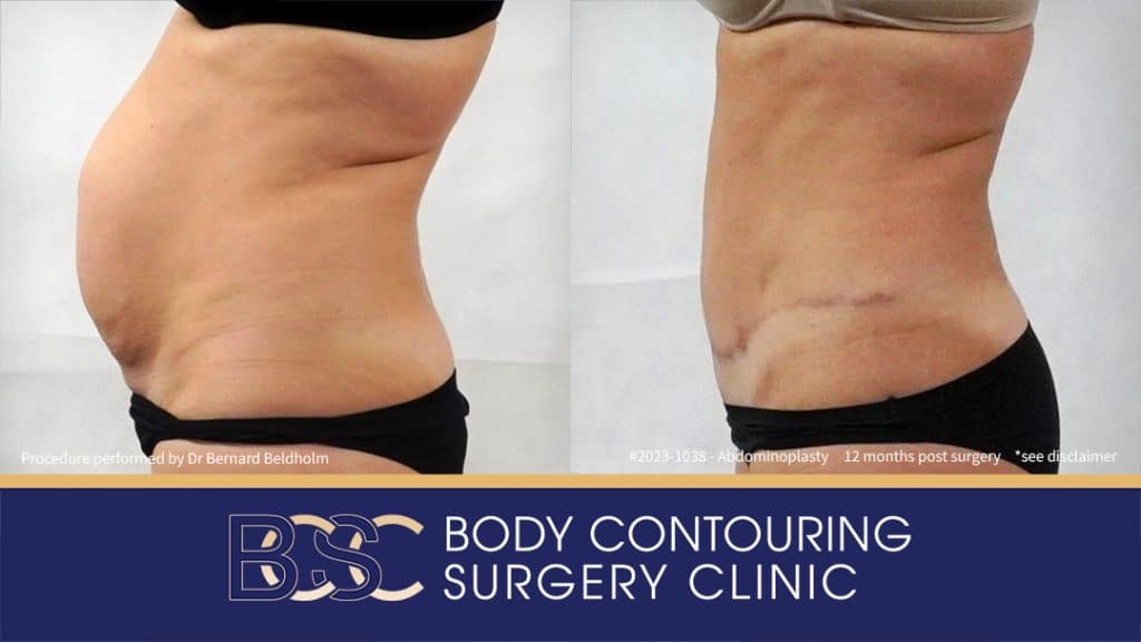 Abdominoplasty with VASER Liposuction (Suction-assisted Lipectomy) and Diastasis Recti Repair | 12 Months Post Surgery | Patient 2023-1038 - Right Side