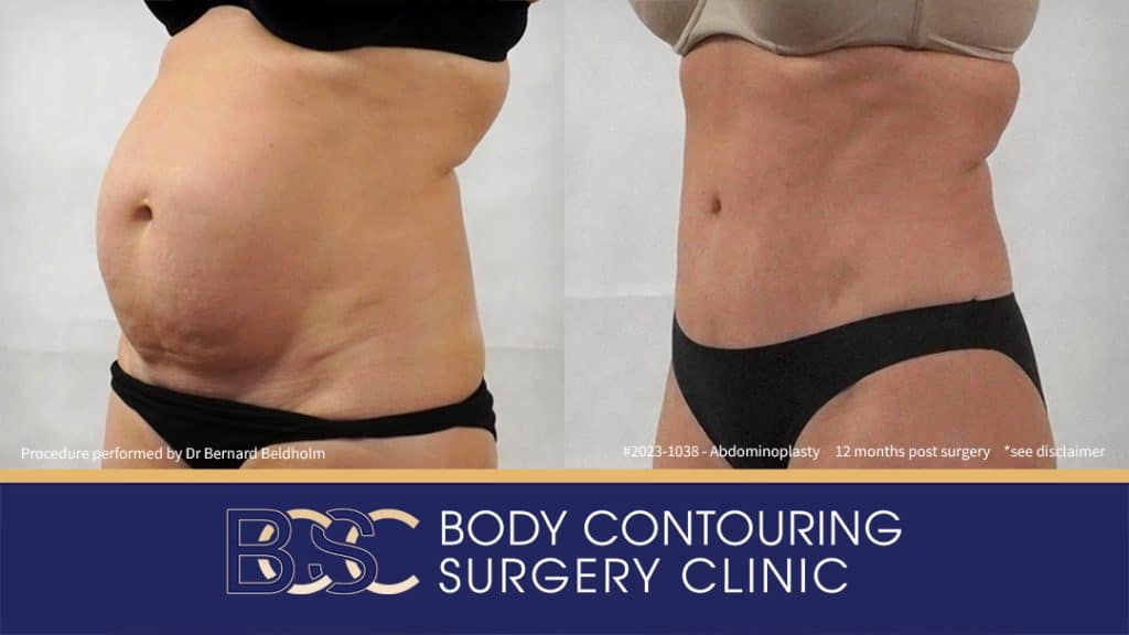 Abdominoplasty with VASER Liposuction (Suction-assisted Lipectomy) and Diastasis Recti Repair | 12 Months Post Surgery | Patient 2023-1038 - Right
