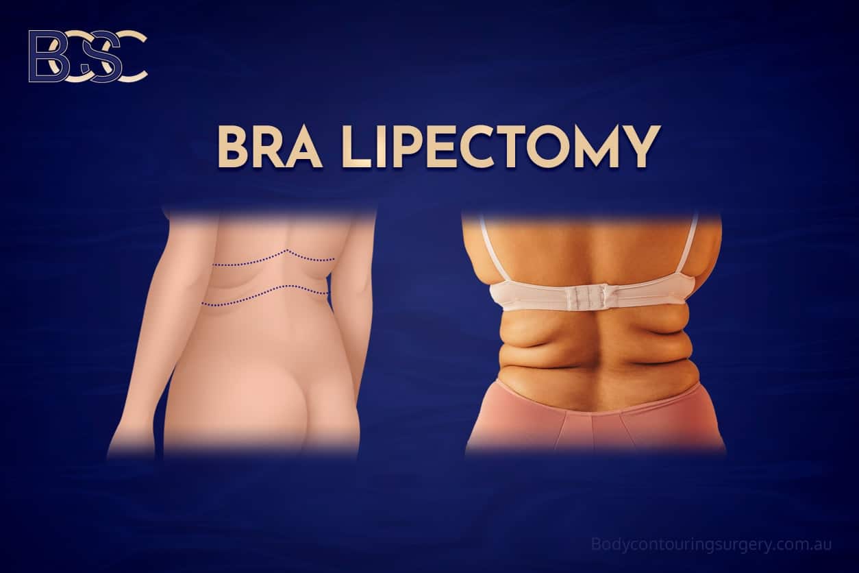 Bra Lipectomy - BCSC