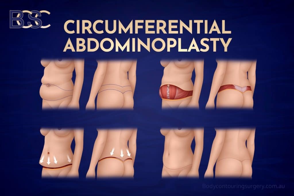 Circumferential Abdominoplasty (Belt Lipectomy)