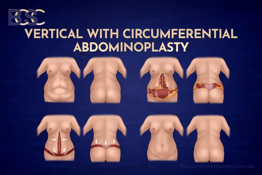 Circumferential Hybrid Abdominoplasty Combining a Vertical Lipectomy with Belt Lipectomy