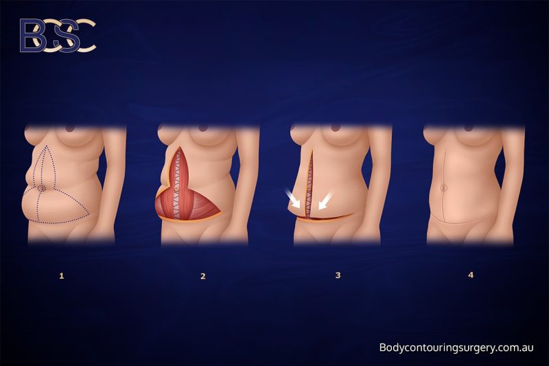 Comparison With Lower Body Procedures