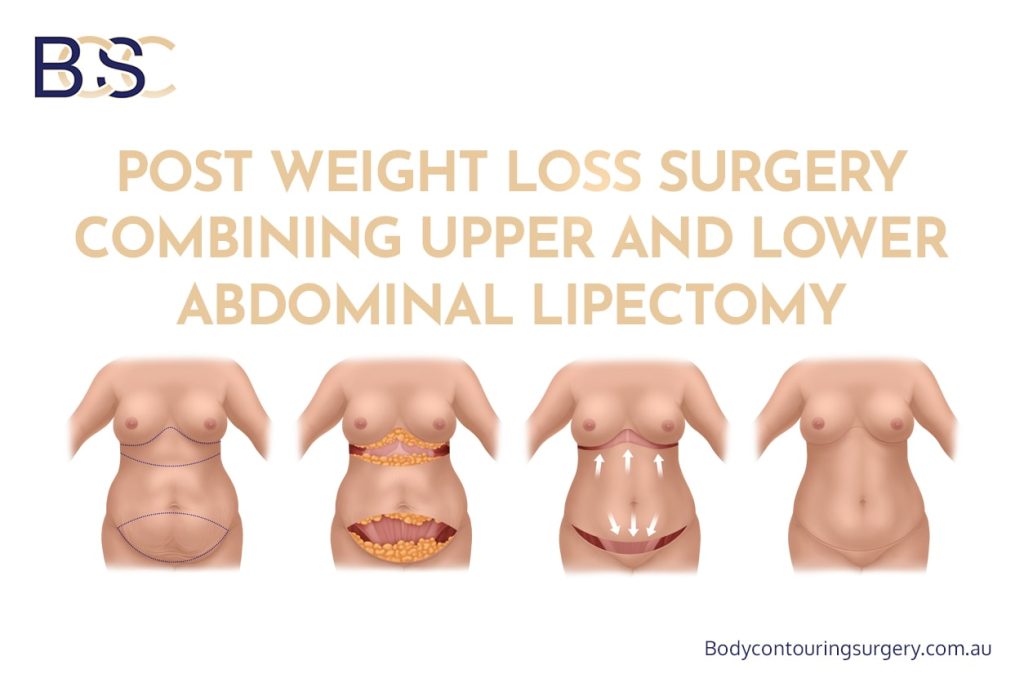 Post Weight Loss Surgery Combining Upper and Lower Abdominal Lipectomy