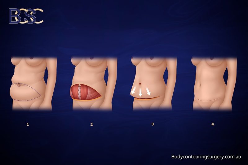 Standard Abdominoplasty