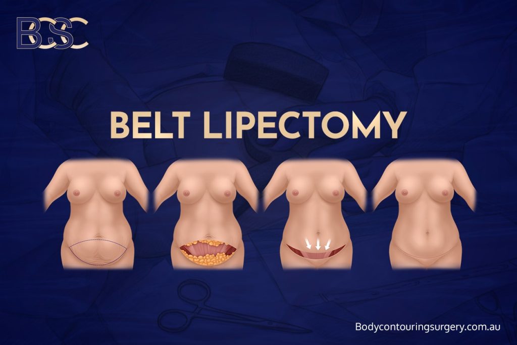 Understanding abdominal lipectomy