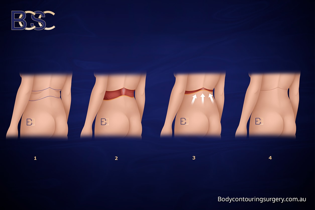 What is Bra Line Lipectomy (upper back lipectomy)