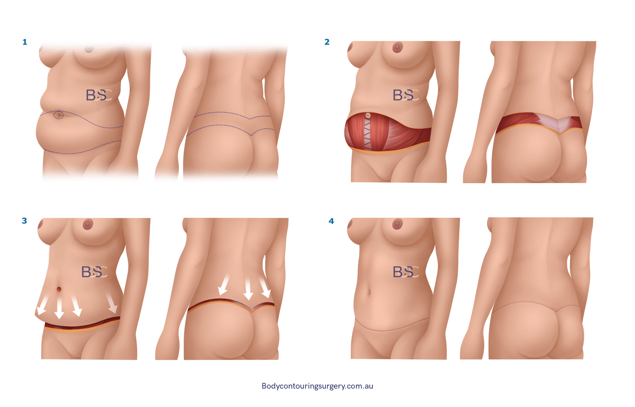 Belt lipectomy (Lower body lift) Belt lipectomy (Lower body lift)
