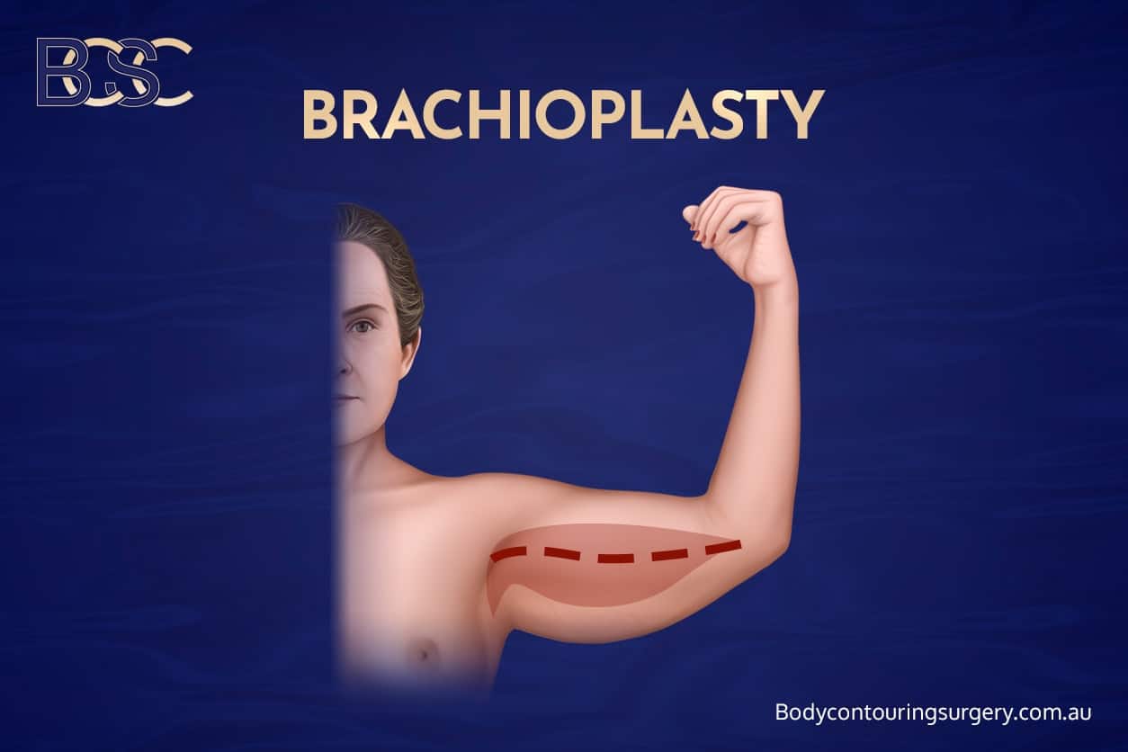 Arm lift (brachioplasty) – Removes excess skin from the upper arms