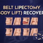 Circumferential Abdominoplasty Complications Post Weight Loss: What to Expect, Why They Occur, and How They Are Managed