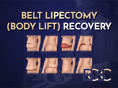 Circumferential Abdominoplasty Complications Post Weight Loss: What to Expect, Why They Occur, and How They Are Managed