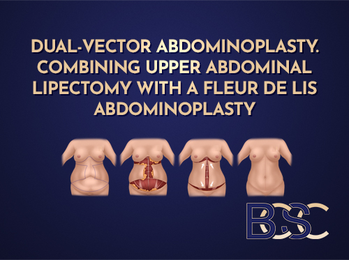 Dual-Vector Abdominoplasty. Combining Upper Abdominal Lipectomy with a Fleur de Lis Abdominoplasty.