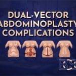 Dual-vector Abdominoplasty Complications