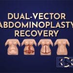 Dual-vector Abdominoplasty Recovery
